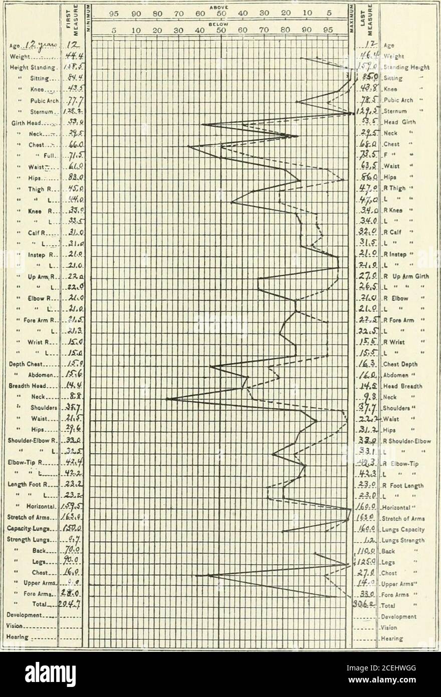 . Annali di chirurgia. Grafico n° 5. Sezione costola sul lato sinistro (eseguita da DRS. George W. Jacobyand A. H. Friedenberg) per empyema, prima che lei fosse un anno vecchio.Mother notò una leggera curva a S della colonna vertebrale con MOLTO marcato trattamento stoop DI DEFORMITÀ DEL TRONCO. 255 spalle, e un addome sporgente circa sei mesi prima del disordine. La curva potrebbe essere obliterata bv gli sforzi muscolari 29 gennaio 1895. Aprile 13, 1895.. Grafico n. 6. Del paziente. Gli esercizi sono stati iniziati. Il paziente era disposto andapt, e ha mostrato un marcato miglioramento molto rapidamente. Sua madre, una donna molto intelligente, reporte Foto Stock