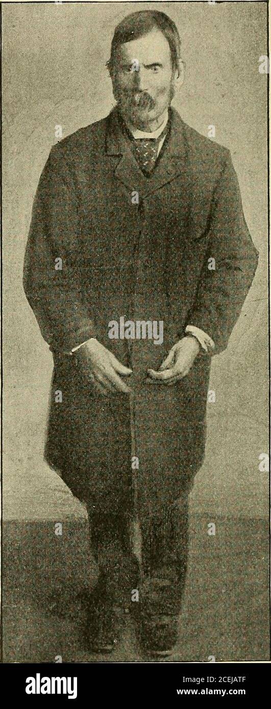 . Un trattato sulle malattie nervose e mentali, per studenti e professionisti della medicina. Agitare la paralisi. Parkinsons disinvoltura. Storia. La paralisi agitans è stata descritta per la prima volta in 1817, byParkinson, di Londra. E' un singolare tributo alla capacità intellettuale di Parkinsons che nulla di essenziale è stato aggiunto alla sisdescrizione della malattia, anche se quasi tutti i ben conoscitori l'hanno considerata. HiSToriY Clixtcal. L'inizio dell'affetto può essere gradualor improvviso, molto generalmente il primo. Di solito inizia in uno delle estremità, anche se occasionalmente inizia nelle labbra, come esso Foto Stock