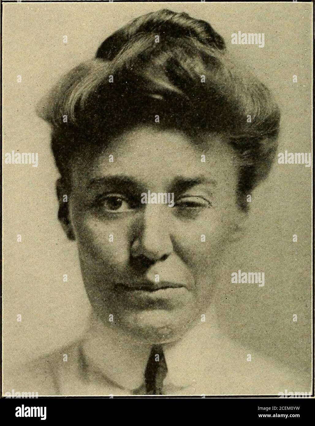 . Malattie del sistema nervoso : per il medico generico e lo studente. Alcune relazioni tra fenomeni motori anormali e metabolismo del calcio, anche la funzionamentodelle ghiandole paratireoidi. È quindi indicata una sperimentazione di sali di calcio e di paratireoidsina tica. Nel torticollis spasmodico sono state tentate procedure operative. Consistono nell'escissione di una porzione del nervo accessorio spinale sul lato interessato e di una sezione delle divisioni primarie posteriori dei nervi cervicali superiori sul lato opposto. Ho visto fallimenti da questa operazione. 33 514 TIC SPASMO FACCIALE SYMPTO Foto Stock