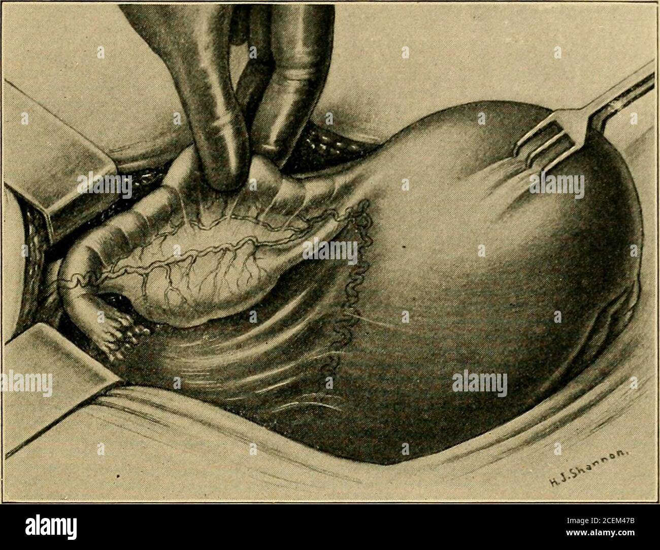 . Infiammazione pelvica nelle donne. Linea: Le ovaie sono sospese diSuturarle o legamenti rotondi. Epitelio del canale cervicale, nella regione fundale, e nelle strutture che circondano il pars interstitialis, che vi è una persistenza dei cambiamenti teinfiammatori che sono già stati descritti. Curtis ha dimostrato che l'interno dell'utero è capableof ridding e si libera di qualsiasi traccia del processo infettivo; quindi, deve fare appello a qualsiasi di una notevole esperienza che, in una givencasi di infezione cronica specifica, coinvolgendo la cervice e i tubi, acure ca Foto Stock