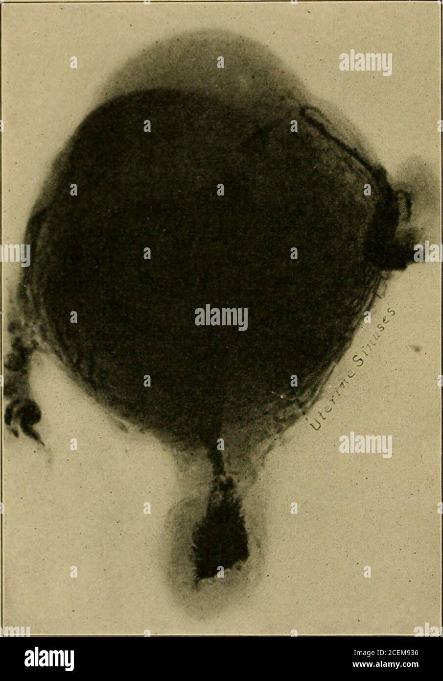 . Infiammazione pelvica nelle donne. Età per raggiungere la cavità uterina, dove, in condizioni favorevoli, sono destrizzati dall'azione battericida delle secrezioni utero-ine. Ordi-narly durante la corteof involucri normali con la ritrazione e il drenaggio uterini adeguati,l'utero è capace di sterilizzare la sua cavità.tuttavia, quando la ritrazione e la contrazione sono scarse i batteri congeniti non si moltiplicano con amazingrapidit a causa di coaguli di sangue teretainati che agiscono come mezzi di coltura, Ma molti guadagnano l'entrata ai tessuti uterini andpara-uterini, come è stato mostrato da Sampson, attraverso il Foto Stock