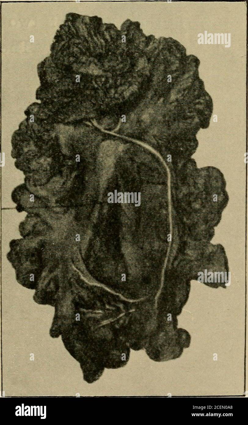 . Sull'ernia retro-peritoneale : essendo le conferenze 'Arris e Gale' sulla 'anatomia e chirurgia della fossa peritoneale' : consegnate al Royal College of Surgeons of England nel 1897. VI. A. – ERNIA DUODENALE DESTRA. La linea dell'arteria mesen-terica superiore. VI. B. – ERNIA DUODENALE DESTRA. IL SAC È VUOTO 176 DESCRIZIONE DELLA PIASTRA VII VII.-CAMPIONE 1281. ST. OSPEDALE THOMASS. 1a cecum, ecc., con la porzione terminale dell'ileo. Dietro il colon ascendente sono due sacche capacitivi di peritono, posti l'uno immediatamente sopra l'altro, e freelycommunicating con la generale peritoneale ca Foto Stock