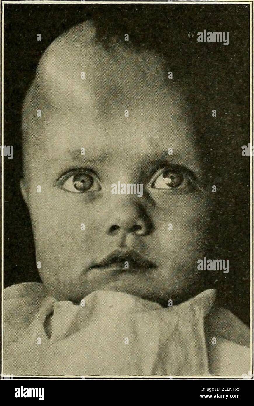 . Malattie dei bambini. Fig. .3.-Meningocele.. Fig. 4.-Meningucolc, diilil ■A^al sette mesi. 74 MALFORMAZIONI CONGENITE l'operazione nel meningocele è molto più favorevole che in enceplialoceleor liydrencefencefricele. Encephalocele. - questo consiste non solo delle membrane del cervello ma anche del tessuto cerebrale. Il tumore non si collega con nessuno dei ventricoli e, se è presente del liquido, si trova nella porzione esterna del sacco, immediatamente sotto la pelle e i tessuti sottostanti. L'apertura nel cranio è solitamente più grande che in un meningocele e il thetumor è generalmente piccolo e non pedunculated Foto Stock