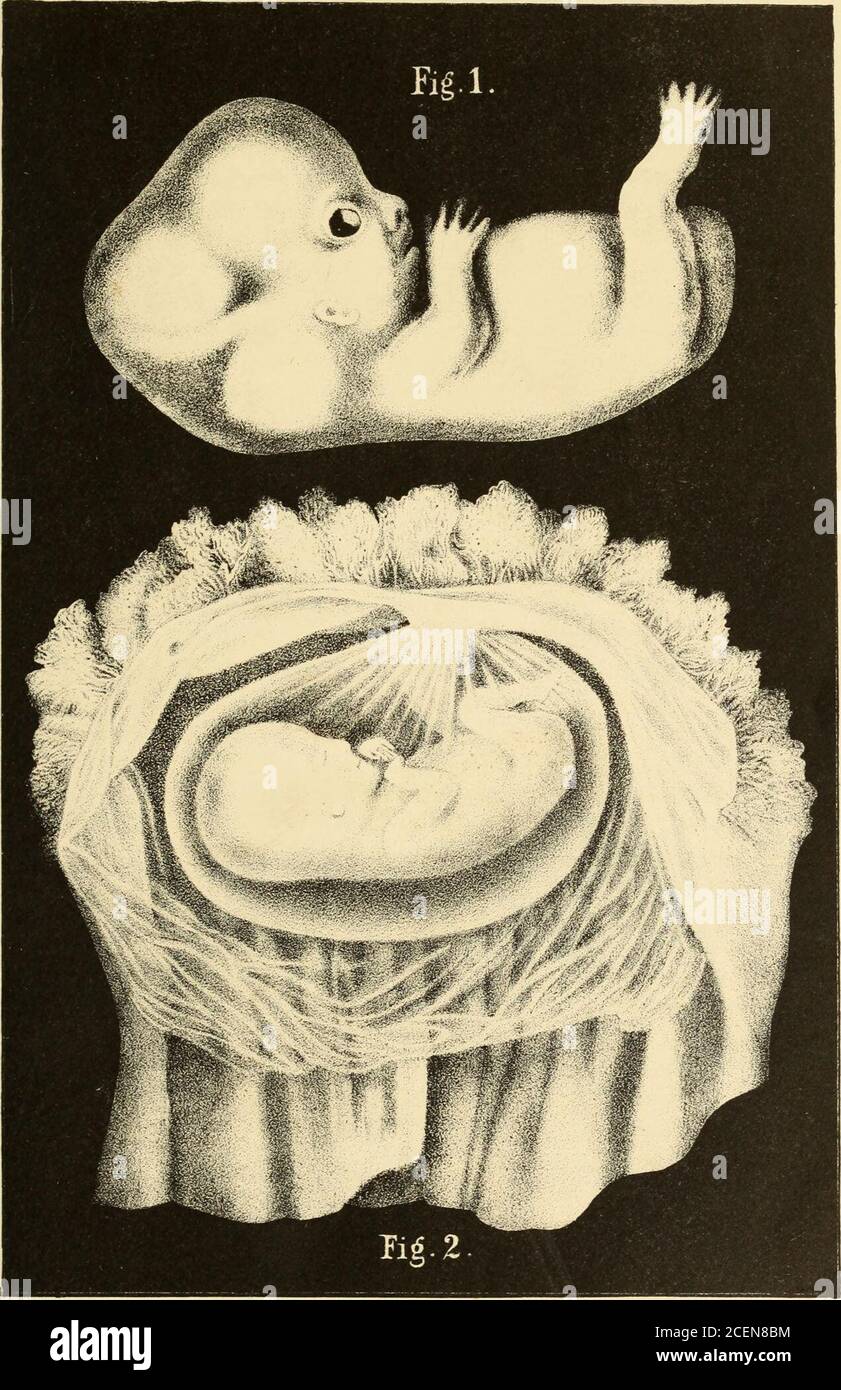 . La scienza e l'arte dell'ostetricia. Fig. 47.-1, esocborione ; 2, blastodermicorione ; ?/, vescicola ombelicale ; a, am-nion ; p, pedicolo di allantois. In forma di embankmentAt questa volta la vescicola ombelicale Fig. 48.. Fig. 1.-embrione umano, alla nona settimana, rimosso dalle membrane; tre volte la dimensione naturale (Erdl).Fig. 2.-embrione umano, alla dodicesima settimana, chiuso nell'amnione; dimensione naturale (Erdl). SVILUPPO DELL'OVULO. 53 è ancora molto grande. L'allantois, come la vescicola ombelicale e l'intestino, è composto da due strati derivati rispettivamente dallo strato interno di Foto Stock