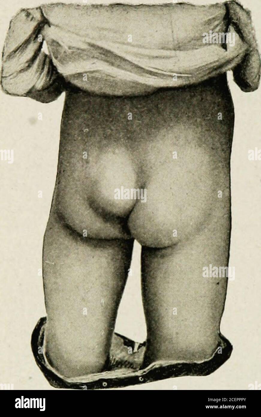 . Le malattie dell'infanzia e dell'infanzia. Dipende dalle condizioni di asso-ciated. L'infezione del tumore può avvenire con la seccatura, i germi che passano attraverso la parete del sacco. Se l'apertura comunicante con il canale spinale è piccola, questa infezione può eccitare infiammazione limitata alla parete del sacco, e provocare una cura di. La spina bifida, di solito con impastamento. Abbiamo visto un caso di questo tipo in agirl di dieci anni in cui questo è accaduto in infanzia. Il sito del tumore del primo era contrassegnato da una grande e densa cicatrice, e vi era ancora una parziale paralisi delle gambe rimeminata. Se gli openi Foto Stock