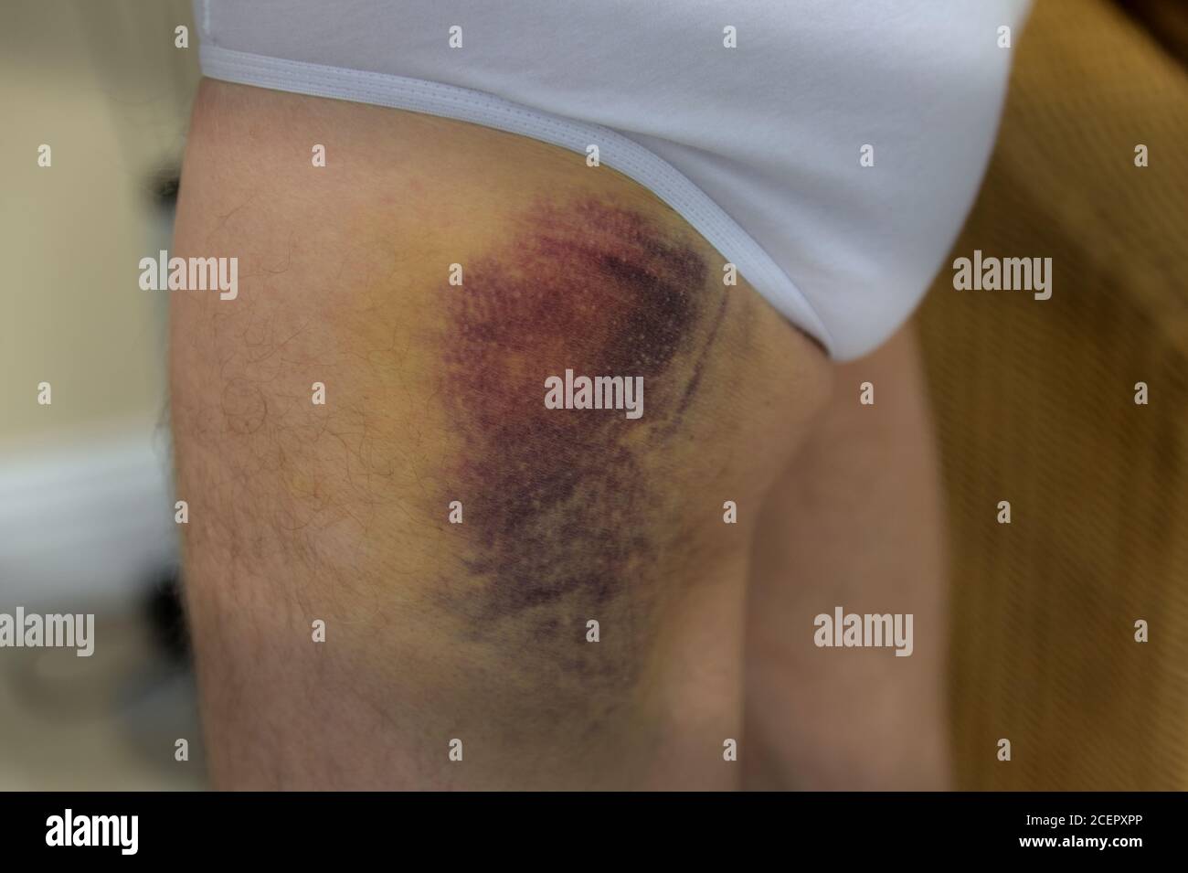 Primo piano di una gamba malamente livida Foto Stock