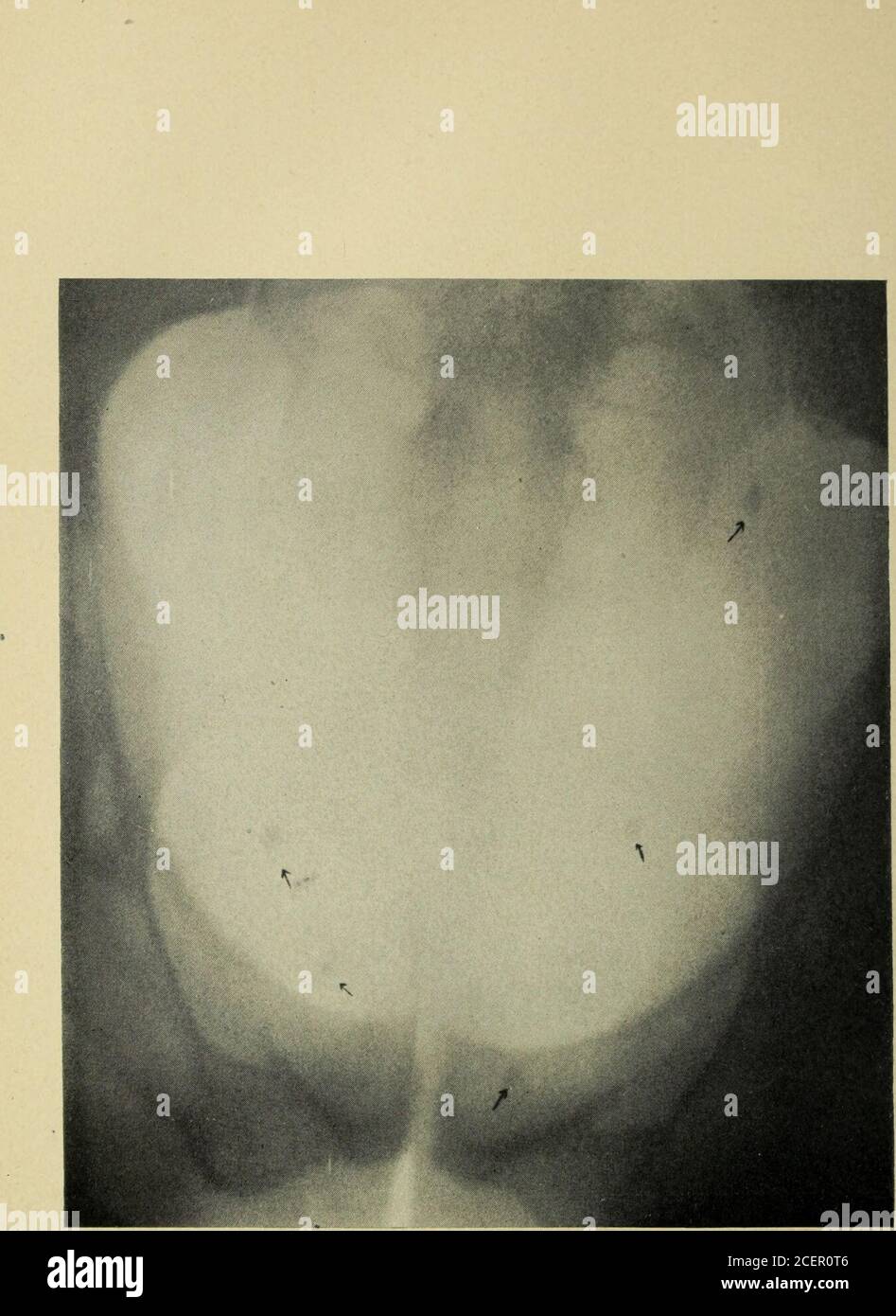 . Operazioni dell'Associazione chirurgica e Ginecologica del Sud. Fig. 4.-caso V (Man.) Questa pietra si è spostata dal catetere ureterale e latervoata. Lato sinistro. Fig. 5.-caso VI. (Man.) Le ombre in questo caso simulano fortemente la pietra, ma a causa della posizione esterna e la penombra sono stati pronunciati fleboliti. Foto Stock