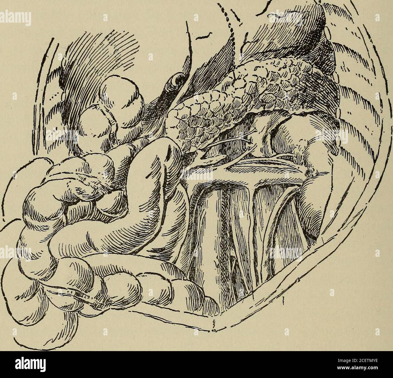 . Patologia postmortem; manuale del tecnico degli esami post mortem e delle interpretazioni da trarne;. follicoli linfoidi d. Non sono state osservate alterazioni specifiche del sangue. Uno dei casi più marcati di pigmentazione dell'addome che ho mai visto era quello di agirl che aveva subito un'operazione per la rimozione di una grande cisti droide dell'ovaio. È possibile che in questo caso la semilunarganglia o le surrene siano state influenzate dalla pressione o altrimenti. In due 1 Letulle considera la formazione di una cavità centrale come solitamente dovuta al trauma-tismo nella sua rimozione o al post-mo Foto Stock