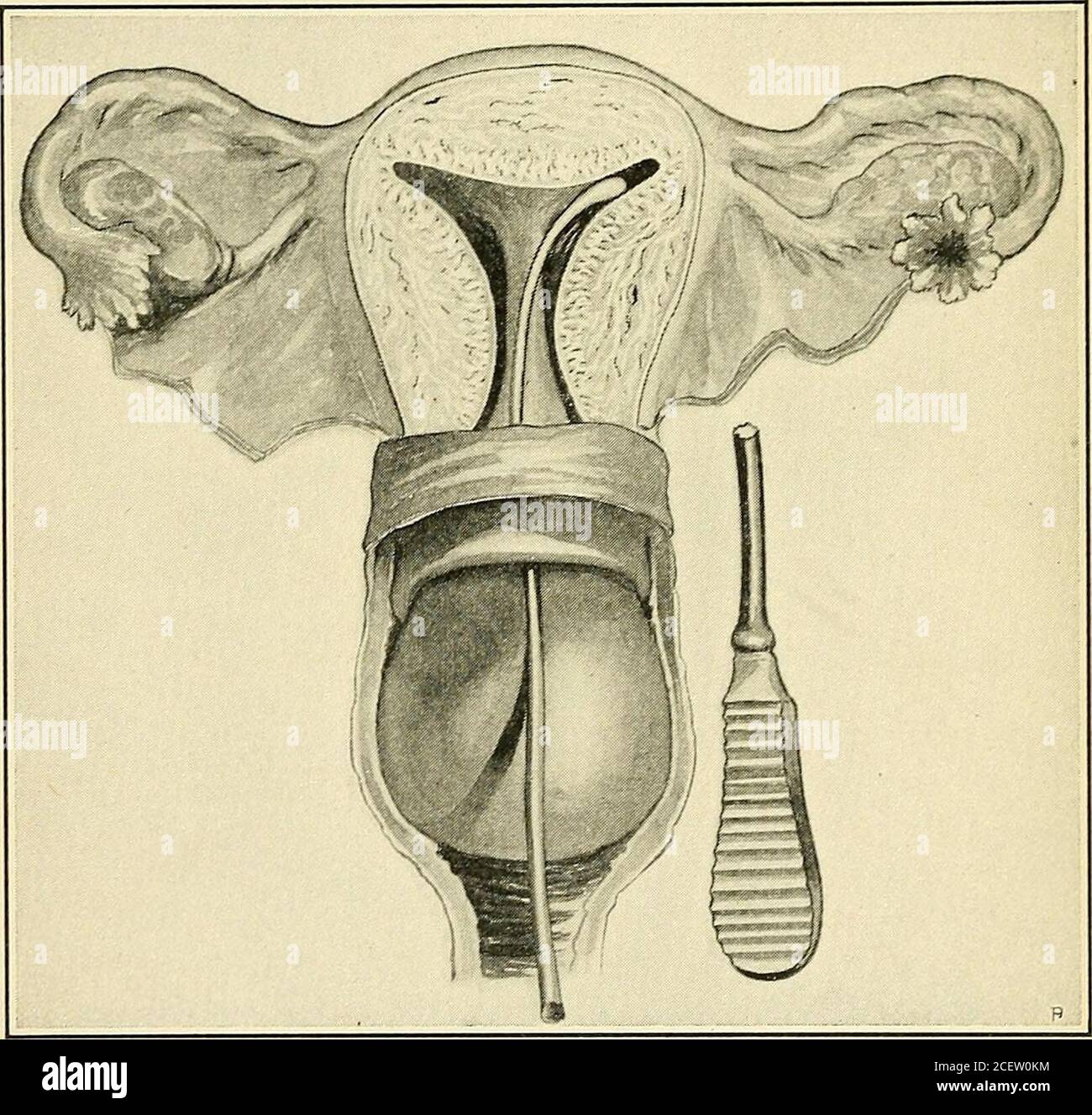 . I principi e la pratica della ginecologia : per studenti e professionisti. -canale vicale o può essere ritorto con conseguente gangrene del thetumor e distacco spontaneo e cura, ma non uncomonlla massa estrusa rimane edematosa ed emorragica, una salute del menaceto o un distruttore di vita. 350 TUMORI, GRAVIDANZA TUBALE, MALFORMAZIONI. Le adesioni possono formarsi tra un tumore intra-iterino e l'endo-metrium o mucosa cervicale, e mediante obliterazione parziale o completa della cavità uterina bloccano le secrezioni all'interno dell'utero. 3. La miomata subperitoneale, talvolta chiamata subseria, può essere beithe Foto Stock