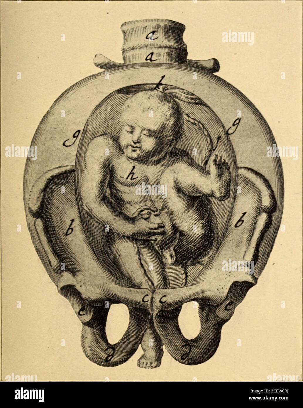 . Operazioni dell'Associazione chirurgica e Ginecologica del Sud. Fig. 15.-Copperplate from the Thesaurus Anatomicus, Ruysch, 1701.. FLG. i6.-Woodcut from the New Light for Obstetricians and Midwives,Deventer, 1701. Foto Stock
