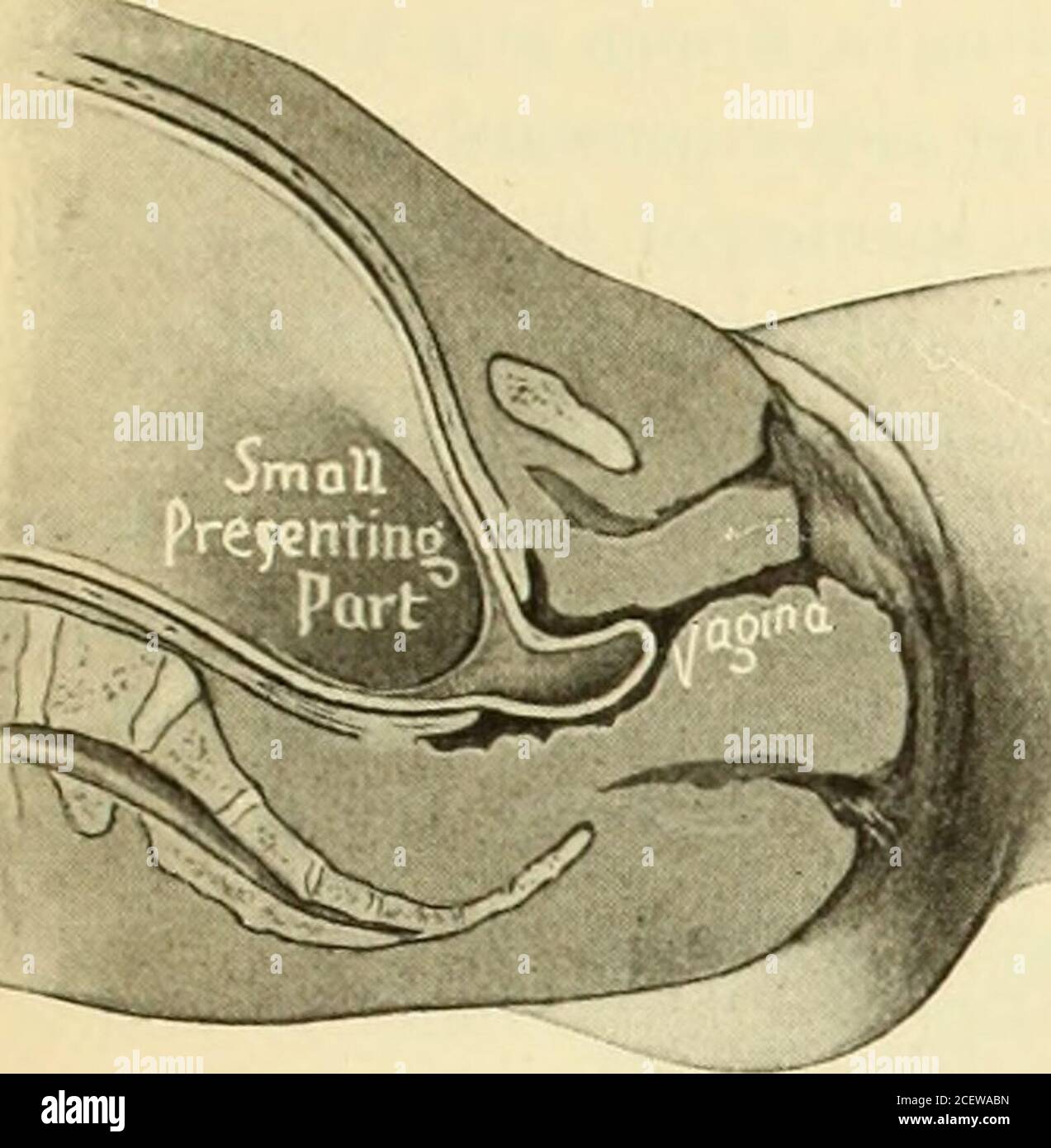 . Un libro di testo americano di ostetricia. Per professionisti e studenti. Fig. 176.-forma delle membrane durante la dilatazione, vetro-orologio (Varnier): La parte di presentazione è grande e riempie la cervice (una sesta dimensione naturale). Fig. 177.-forma di membrane con riempimento meno effi-cente di cervice e pelvi, e più grande quantità di acque prua (modificato da Varnier). Nella forma quando la cervice è stretta e la parte di presentazione non lo riempie, presentazioni di ginocchio o spalla asin (Fig. 178); (5) a pera (Fig. 179), COME FISIOLOGIA DEL LAVORO. 331 dove il feto è morto e macerato; 15 (6) doppio, come p. Foto Stock