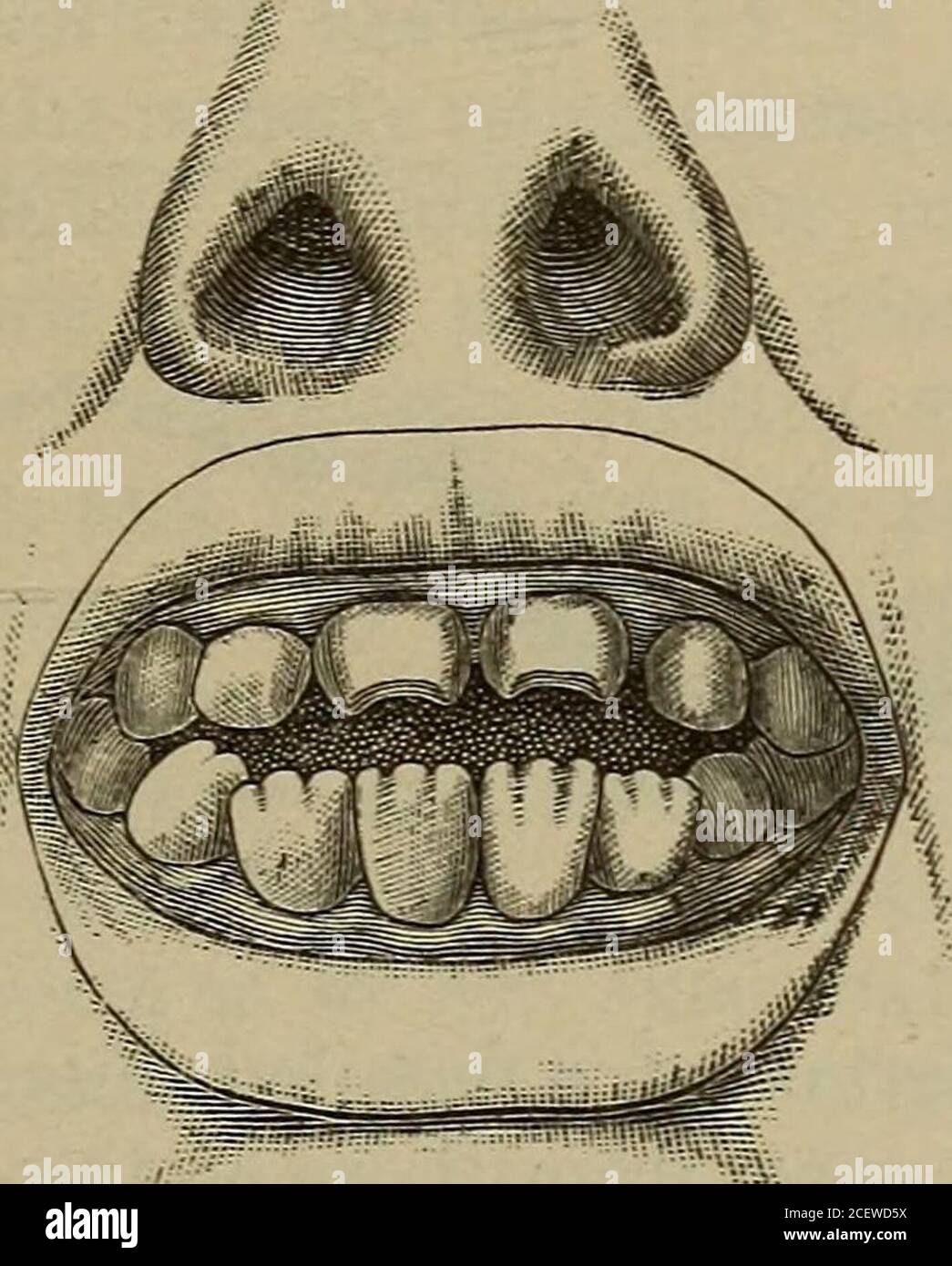 . Il manuale di riferimento pronto delle malattie della pelle. tle, se c'è, ulcerazione. Raramente recidive. Si differenzia dalla pemfigusina che si verifica sulle palme e sulle suole, risparmiando il tronco, e nella profonda cachessia e la presenza di altri segni della sifilide. La sifilide tubercolare non è comune ed è sempre una lesione alata. Anche se può essere visto già nel sessantacremese, è più adatto a verificarsi molto più tardi come UNA SIFILIDE recidivante. 509 sifilide. Nell'aspetto e nel corso assomiglia al samelesion della sifilide acquisita. La sifilide gommata è anche una manifestazione tardiva della malattia, ed è s. Foto Stock