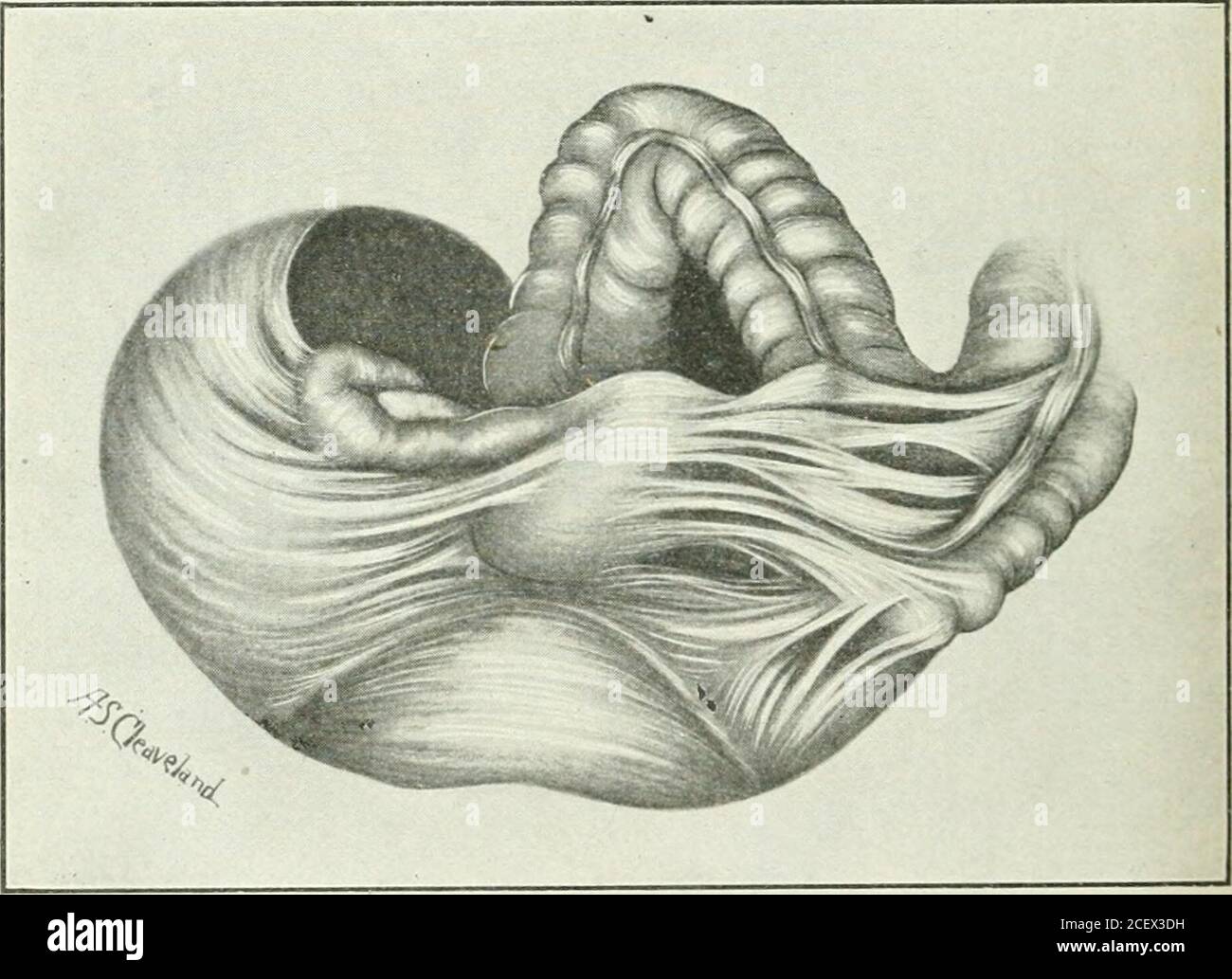 . Un manuale di gynæcology e chirurgia pelvica, per studenti e professionisti. onin chirurgia pelvica. Quando i tubi sono occlusi ma liberi da adesioni dense l'operazione è semplice, mentre il rimoval di una grande pirosalpinx densamente aderente che ha per-forato nel retto o nella vescica è uno dei più difficili in chirurgia. All'apertura dell'addome in circostanze telatter si può confrontarsi con vecchie adesionicopertura sull'intera cavità pelvica, e queste possono coprire la massa adense costituita dagli organi pelvici, dall'omentum, dall'intestino tenue e dalla vescica. L'inexperienc Foto Stock