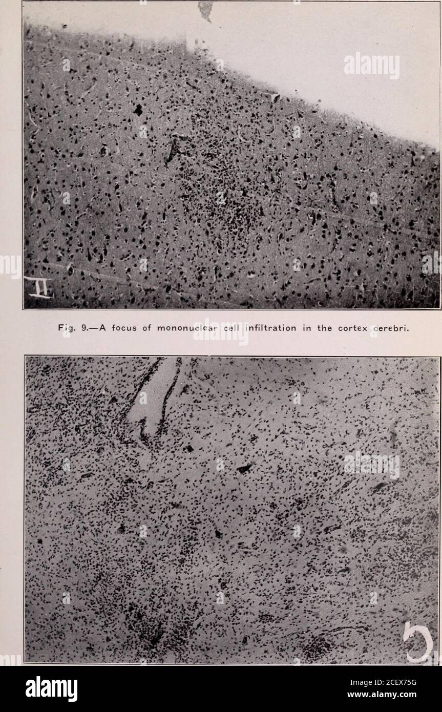 Pediatria. Fig. 8.-che mostra l'infiltrazione avventiziale di lenti a  immersione di cellule. Si noti cellule ike themonuclear ed endoteliali -1  nello spazio linfatico intra-adventiziale. 10.-Quinto segmento cervicale  che mostra l'infiltrazione del