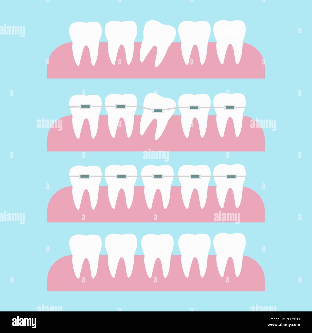 Correzione dei denti con le bretelle ortodontiche. Illustrazione del vettore di trattamento ortodontico del dente. Prima e dopo il concetto di correzione dei denti delle bretelle dentali Illustrazione Vettoriale