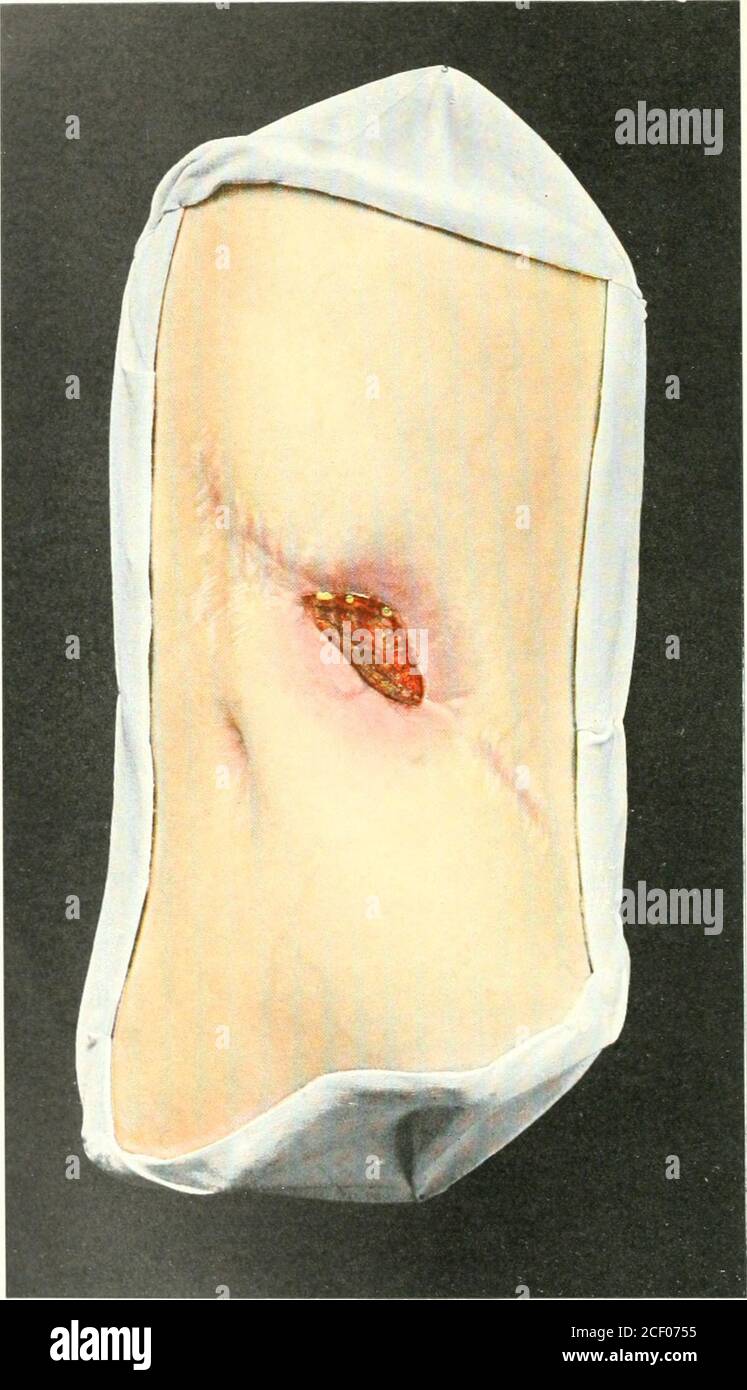 . Atlante della chirurgia clinica; con particolare riferimento alla diagnosi e al trattamento per i professionisti e gli studenti. Fig. 55. Oranulationes et Tranplantationes. Rebman Company, New York. Bockenheimer, Atlas. Scheda. XL. Fig. 56. Fistola ex corpore alieno. PT^l^rn^n fnynn^nv W*»of Vrlf FISTULA EX CORPORE ALIENO {fistola da corpi estranei)piastra XLIII, Fig. 56. Come risultato dell'incisione di un ascesso paranefritico, è rimasta una fistola che, nonostante il drenaggio, il tamponamento e la raschiatura ripetuta, non ha guarito. La pelle circostante è infiammata ed edematosa. Le granulazioni all'apertura della fis Foto Stock
