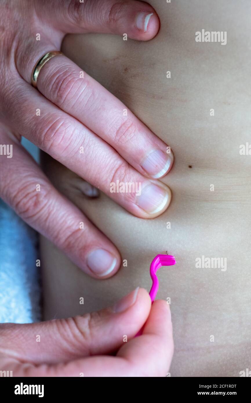 Madre che rimuove un segno di spunta sul ventre della figlia Foto Stock