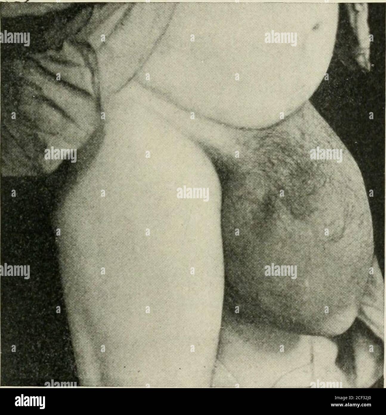 . Ernia addominale : diagnosi e trattamento. Enormotis destra ernia scrotale in un uomo oltre 70 anni. Completamente riducibile ma non raggiungibile da qualsiasi capriolo che possa essere tollerato. Contenuto, intestino crasso e piccolo e piccola quantità di omentum. Avendo un feeliig un po' come quello di un denso, ampio tendine.al punto in cui è entrato nell'addome, è stato bunchedtogether in una massa grande come un avambraccio adulto, appena belowthe gomito, e apparentemente quasi come inflessibile. COMPLICAZIONI NELLA CURA CHIRURGICA. 275 coloro che hanno operato sulla larg-e liernia, realizzeranno pienamente il quasi insormontabile Foto Stock