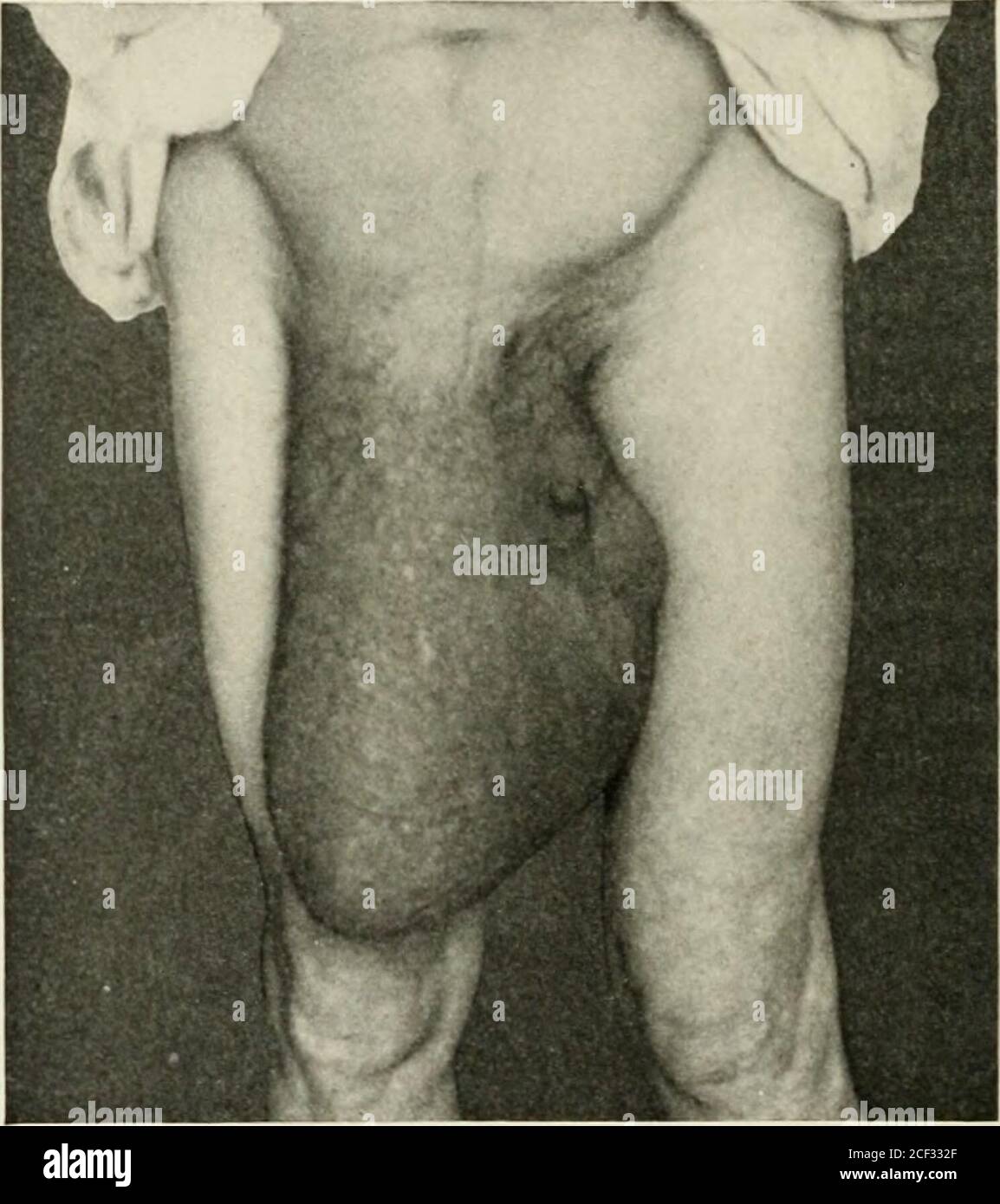 . Ernia addominale : la sua diagnosi e il suo trattamento. Carattere insolito (fig. 155). Questa mesen-tery era una massa a forma di ventaglio, a forma di tavola, completamente un pollice di spessore. Fig. 153.. Enormotis destra ernia scrotale in un uomo oltre 70 anni. Completamente riducibile ma non raggiungibile da qualsiasi capriolo che possa essere tollerato. Contenuto, intestino crasso e piccolo e piccola quantità di omentum. Avendo un feeliig un po' come quello di un denso, ampio tendine.al punto in cui è entrato nell'addome, è stato bunchedtogether in una massa grande come un avambraccio adulto, appena belowthe gomito, e apparentemente quasi come inflessibile. COMPILICATIO Foto Stock