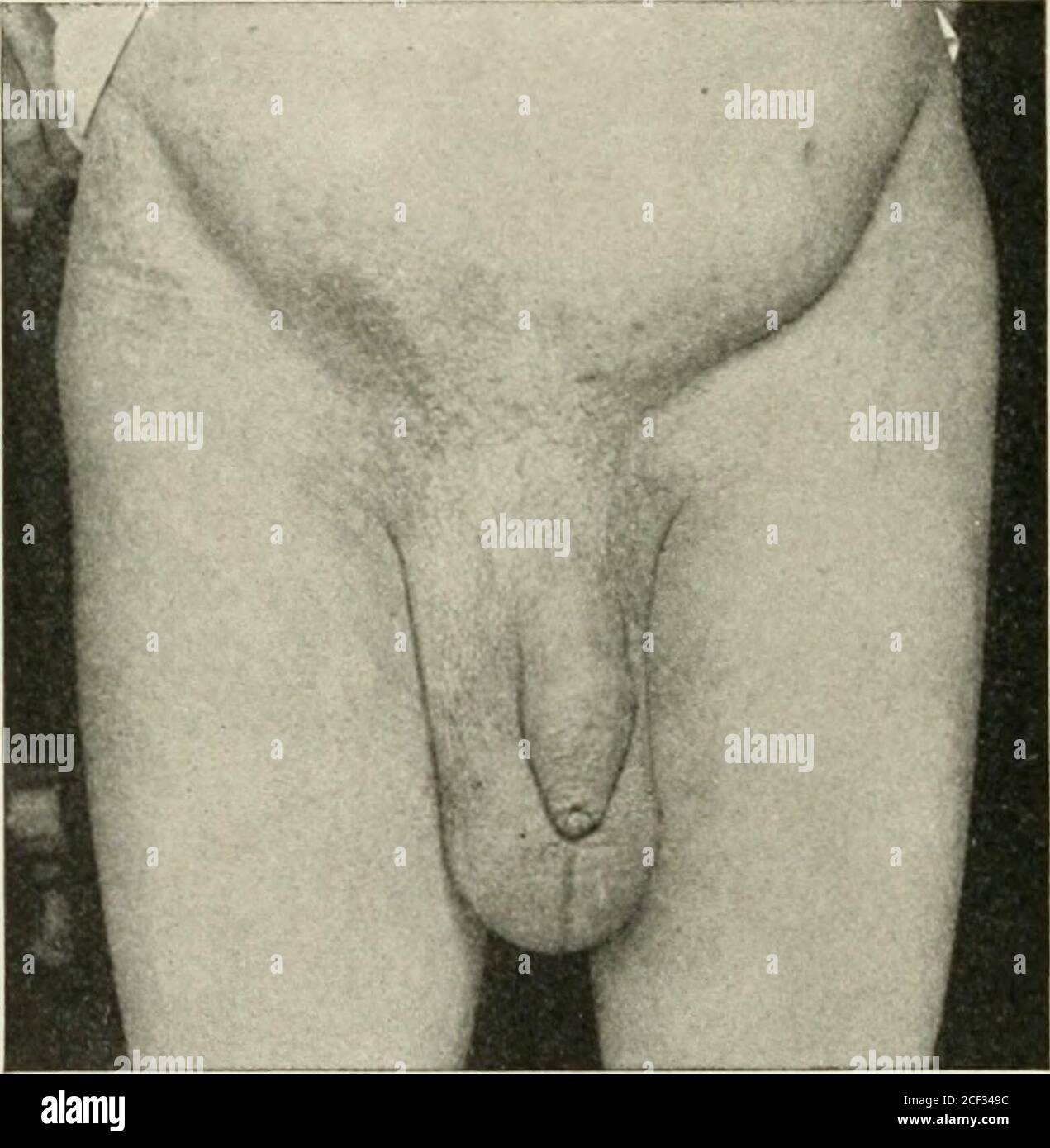 . Ernia addominale : la sua diagnosi e il suo trattamento. In  li il-taiiied. Misura da A a B, 14 pollici; circonferenza. Da C a £>, 2 piedi, 2 pollici. Funzionamento Dec. 4. 1S95; nessuna ricorrenza a 1906. Nessun traliccio usurato. Contenuto, intestino crasso e piccolo, omentum, bladderInside del sacco, e fluido libero. Nota il testicolo destro in B, a sinistra in D. vedere le figg. 151, 152. questo fatto. L'uomo lì mostrato è stato operato per ernia scrotale anenorme e incontrollabile e ha fatto il recupero della richiesta, la guarigione da Unione primaria. A quel tempo ci ernia wasno sul lato sinistro. Cinque anni dopo il rigonfiamento si notò sul lato sinistro (fi Foto Stock