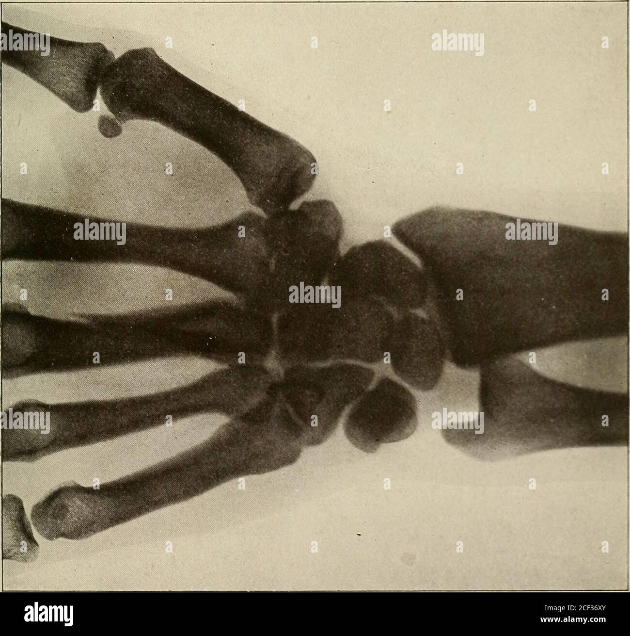 . Un trattato pratico sulle fratture e le dislocazioni. Fig. 1.-polso normale ; maschio adulto. Figura 2. - polso normale; frattura femminile adulta del terzo metacarpale. FRATTURE DELLE OSSA DELL'AVAMBRACCIO. 288 terizzato da una maggiore violenza causale e da uno sfollamento più ampio. Il meccanismo sembra essere avulsione attraverso la corda-come liga laterale che è fissata alla sua punta. Per quanto riguarda la condizione della fibrocartilagine intra-articolare i può essere trovato ma poco positivo, poiché le uniche fonti di informazione sono le autopsie di fratture recenti. I raggi Rontgen non danno alcuna directinformation su questo punto Foto Stock