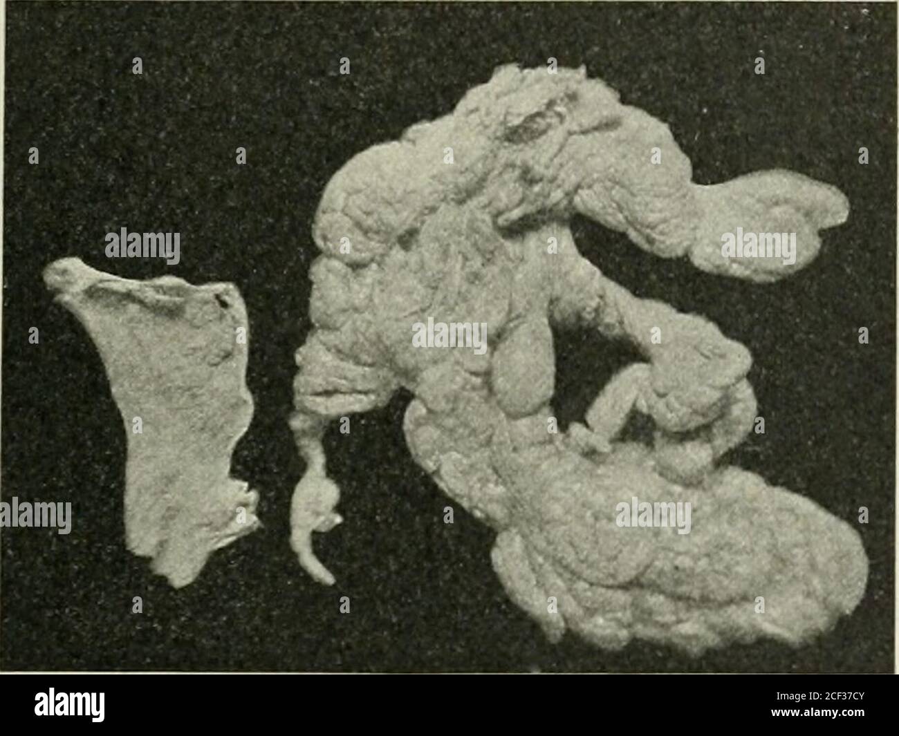 . Ernia addominale : diagnosi e trattamento. Massa di omentum irriducibile dalla quantità e dalla forma. La parte stretta in cima era nel canale. 143) in modo che ogni vaso sanguigno di qualsiasi dimensione considerevole possa essere facilmente visto. La ligazione inizia da un lato di questo slietof omentum e progredisce attentamente attraverso l'altro. COMPLICAZIONI DEL GRASSO NELLA CURA CHIRURGICA. 265 con recipienti molto piccoli è legato in quantità abbastanza buona, ma il recipiente grande è accuratamente eliminato dal grasso circostante e dal decoloramento separatamente. No.2 il catgut cromico è stato usato più spesso come materiale di sutura. .s molti come 25 legature Foto Stock