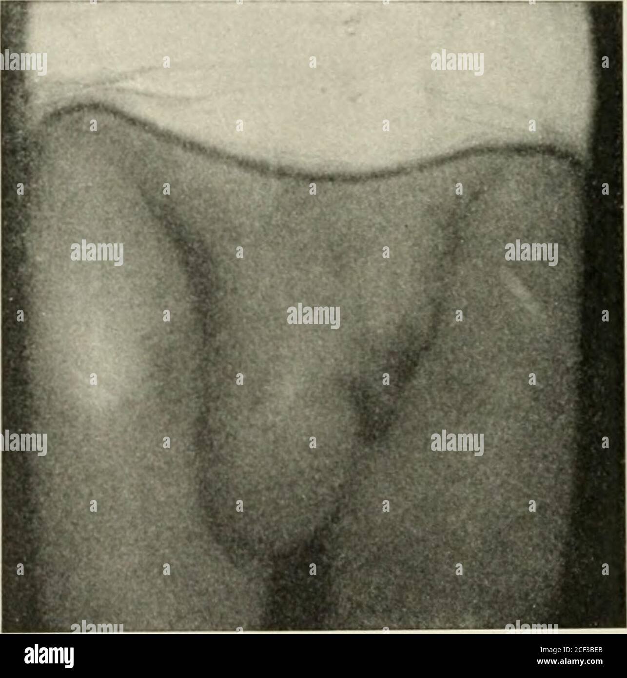 . Ernia addominale : diagnosi e trattamento. Come prima, tre settimane dopo l'operazione. Testicolo in cima ot scroto. Particolarmente responsabile e pericoloso. Queste sacche possono esistere per anni senza protrusione reale dell'intestino, e quando avviene, una piccola articolazione dell'intestino, strangolata sotto la copertura spessmuscolosa, è abbastanza probabile essere trascurata su esame-minzione. Le molte peculiarità indiudali che sono state metate in relazione a questa classe di casi, indicano il loro pericolo excep-zionale in caso di strangolamento; come aderent omentum, 252 ERNIA ADDOMINALE Foto Stock