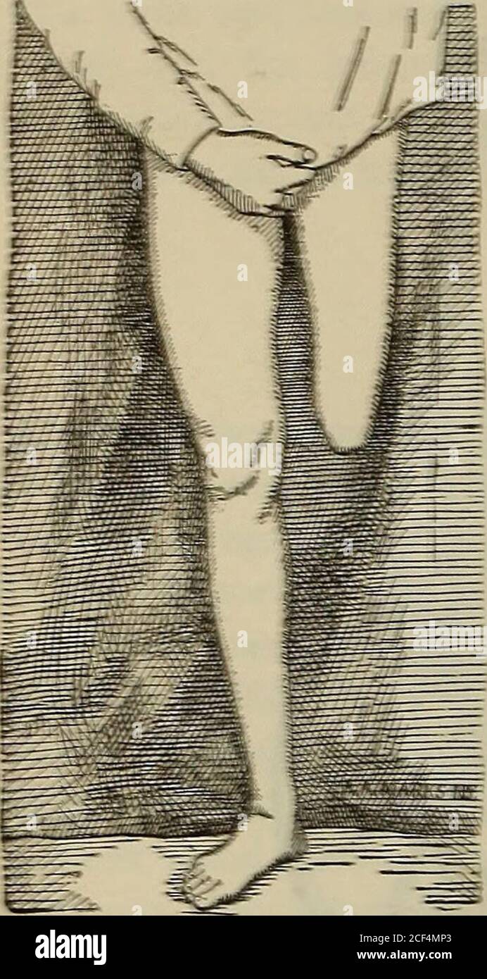 . Un trattato sugli arti artificiali con mani e piedi di gomma ... 560. E il paziente è stato in grado di camminare con la gamba artificiale in modo molto accettabile. Tornò a casa sua in Europa, e riferì, non gradito, che stava seguendo molto bene e in grado di fare affari. 62 A. A MARCATURE, ARTI ARTIFICIALI, XIW TOEK CITT. GAMBE ARTIFICIALI PER AMPUTAZIONI DELLE ARTICOLAZIONI DEL GINOCCHIO. Amputazioni che sono fatte attraverso articolazioni del ginocchio di Tlie providestumps che richiedono trattamento protetico peculiare alle conditioniche esistono in ogni moncone. I ceppi risultanti da tali amputazionipossono essere taperi Foto Stock