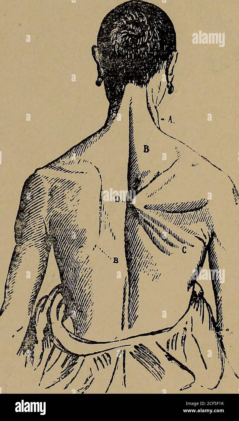 . Anatomia applicata e cinesiologia. 32, dove manca il trapezio destro, mostra l'azione combinata del romboide e del latissimuson sul lato destro. La fossa glenoidea è rivolta verso il basso, e Duchenne afferma che mentre il romboide è in contrattura il soggetto non può alzare il braccio al di sopra del livello del theshoulder. La parte giocata dal romboide nel mantenere la postura normale, come dimostrato da casi difettosi, consiste nel moderare la rotazione in avanti della scapola prodotta dal trapezio, in modo da mantenere l'acromione in basso, e nel mantenere l'angolo inferiore vicino alle costole.soggetti Foto Stock