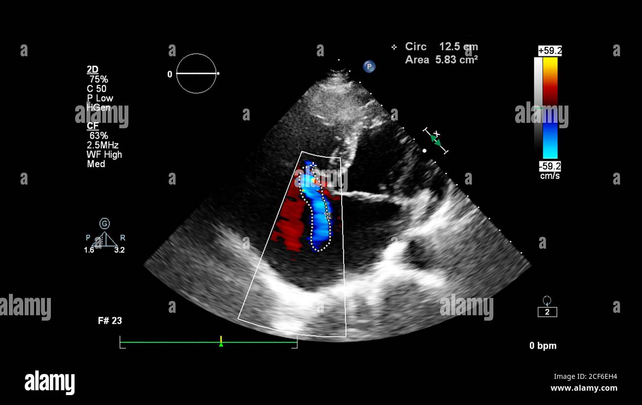 Immagine del cuore durante l'ecografia transesofagea con modalità Doppler. Foto Stock