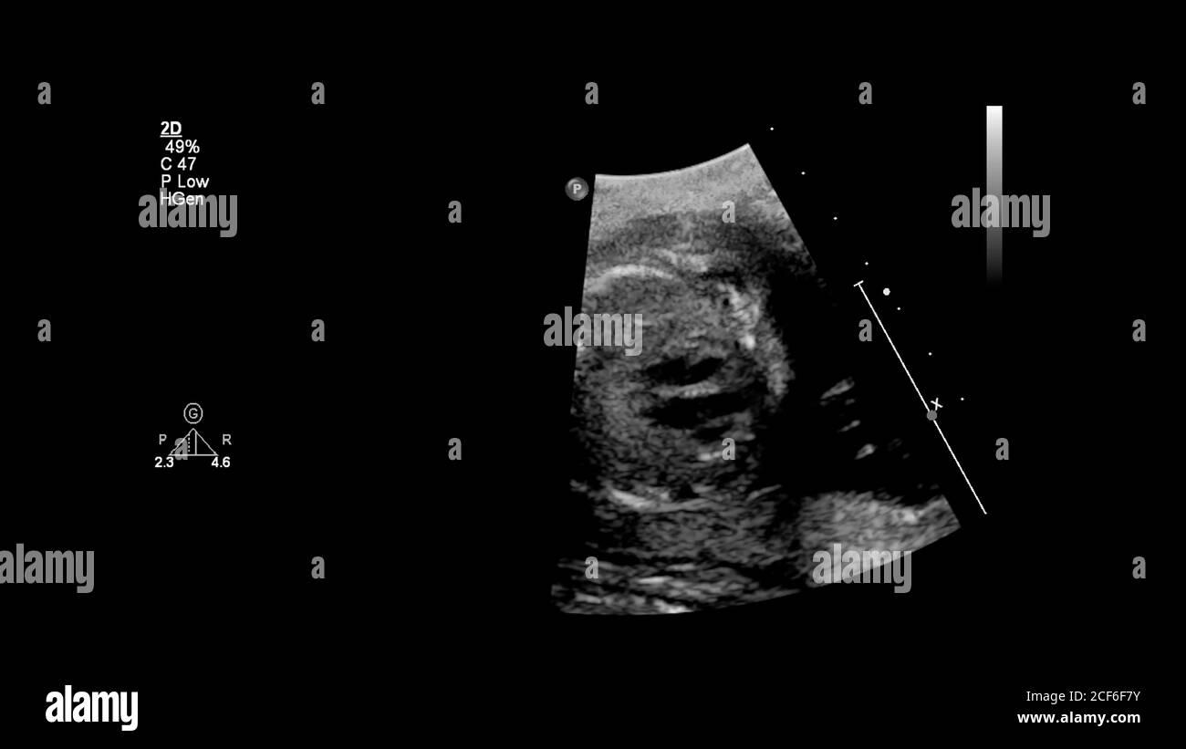 Schermo a ultrasuoni con ecocardiografia fetale. Foto Stock