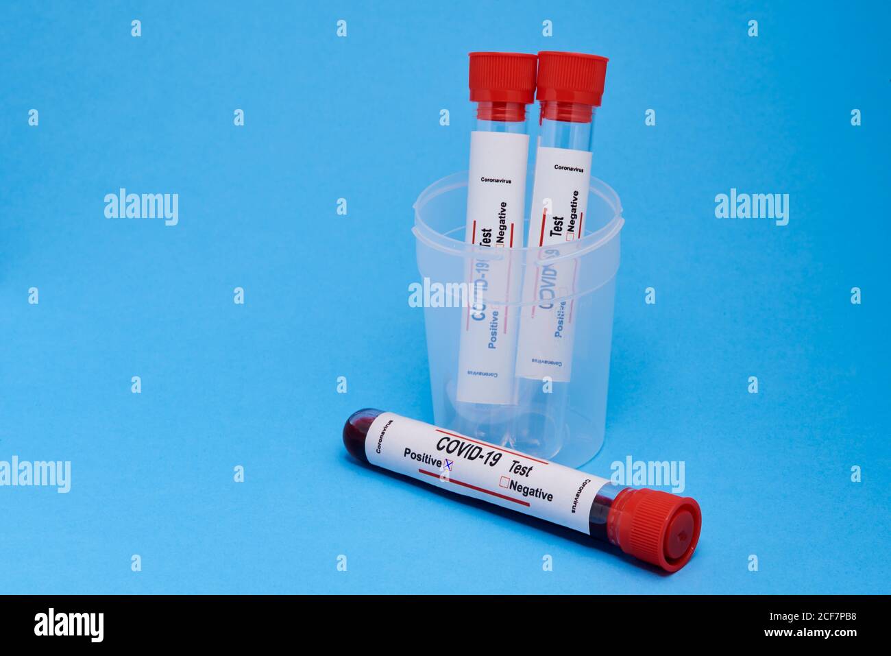 Dalla parte superiore, la provetta per analisi con i campioni di sangue nella provetta coppa in plastica per test diagnostico del coronavirus con contrassegno positivo su sfondo blu Foto Stock