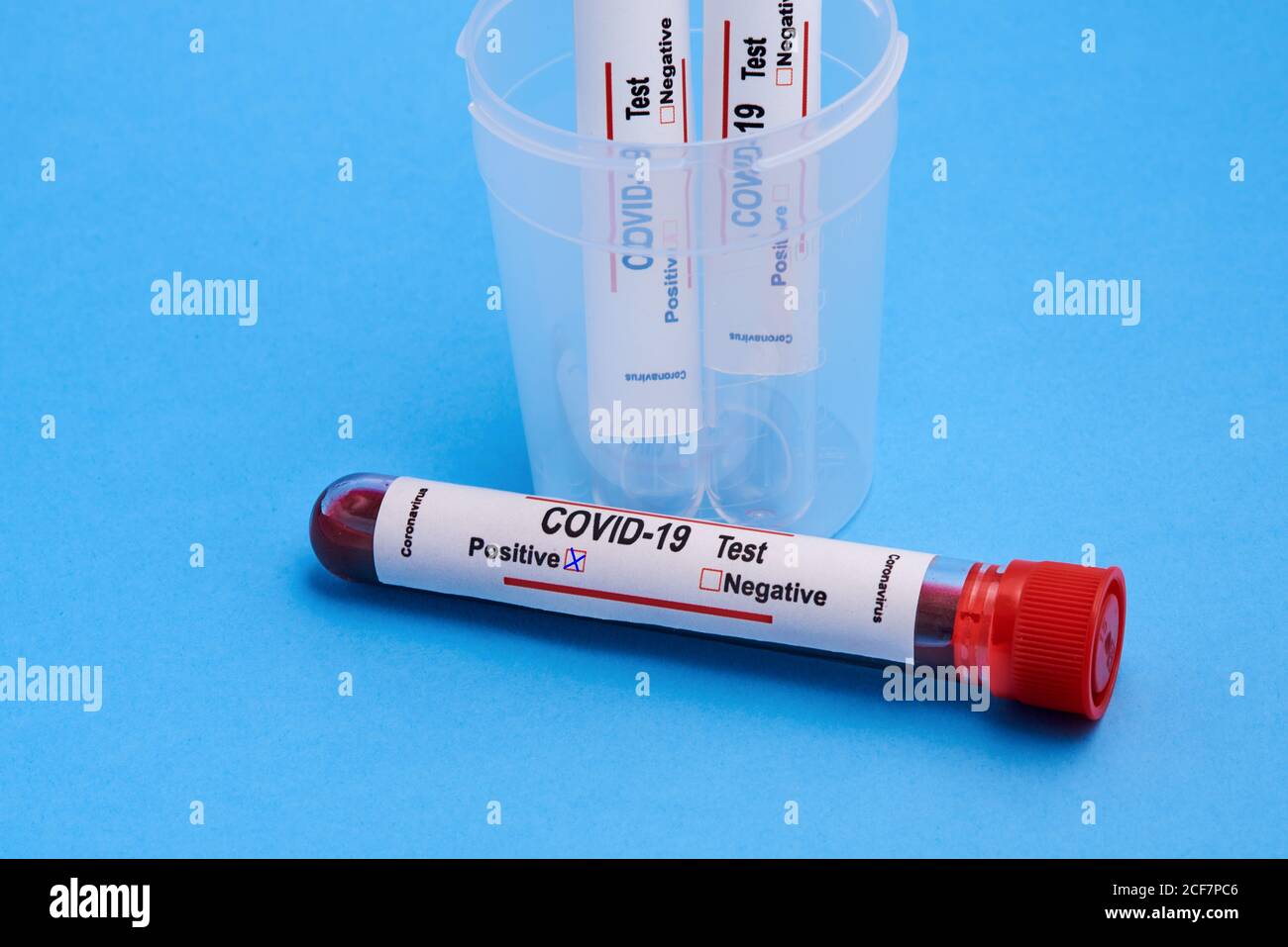 Dalla parte superiore, la provetta per analisi con i campioni di sangue nella provetta coppa in plastica per test diagnostico del coronavirus con contrassegno positivo su sfondo blu Foto Stock