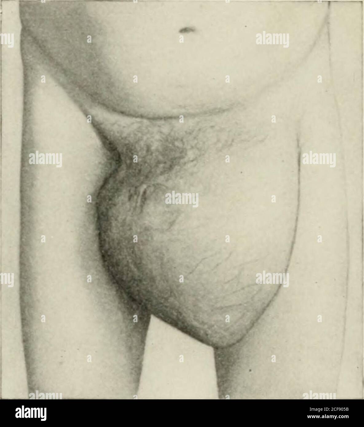 . Ernia addominale : diagnosi e trattamento. La capriate a tazza incernierata per ernia irriducibile. {Macready,) cedono sotto la pressione della capra e dell'ernia per diventare aridulo. In tal caso, nel caso in cui sia stato utilizzato un tampone concavo, esso dovrebbe essere prontamente sostituito con un tampone convesso, per garantire una ritenzione più perfetta. Il cuscinetto convesso deve essere applicato in ogni caso in cui la sporgenza può essere ridotta nel canale ed è di piccole dimensioni. Dove una massa di omentum è aderente nello scroto, eda truss pad è stato applicato attraverso il suo collo, un buon-adattamento, 186 ADDOMINALE HERXL. Forte sospensorio Foto Stock