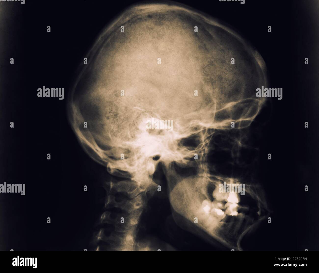 Immagine radiografica del cranio umano della testa della donna adulta isolata sfondo nero Foto Stock