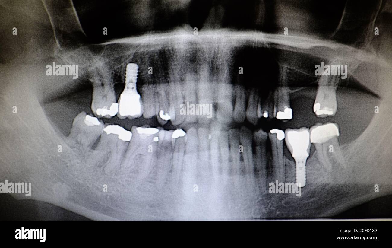 Studio dentistico di 6/30/2020 64 anni di radiografia dell'uomo che mostra twi impianti dentali e numerosi riempimenti Foto Stock