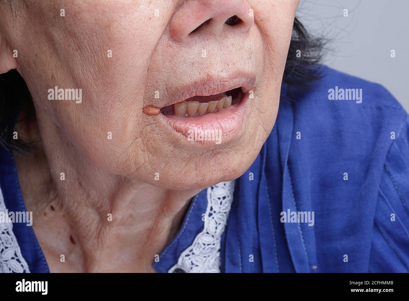 La cheilite angolare è un tipo di infiammazione comune del labbra Foto Stock