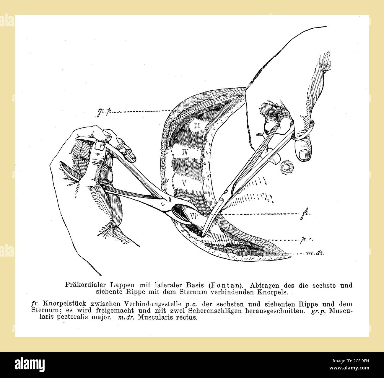 Sanità e medicina: Lobo precordiale, esposizione delle costole con cartilagini sternali, descrizioni tedesche Foto Stock