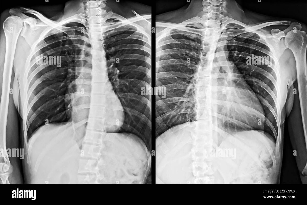 Immagine radiografica del torace umano, lato sinistro e destro. Foto Stock