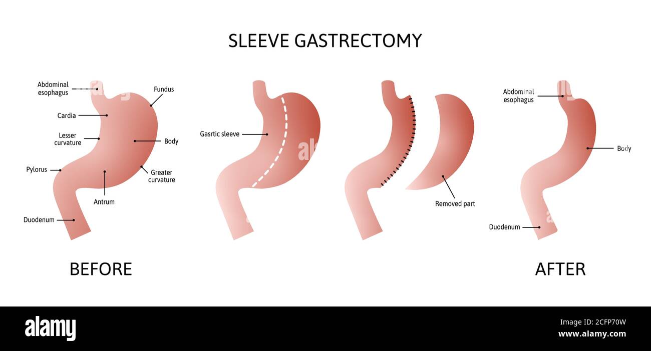 Gastrectomia a manicotto verticale. Anatomia dello stomaco umano isolata su sfondo bianco. Diminuzione del volume dello stomaco. Illustrazione vettoriale contrassegnata da linee. Illustrazione Vettoriale