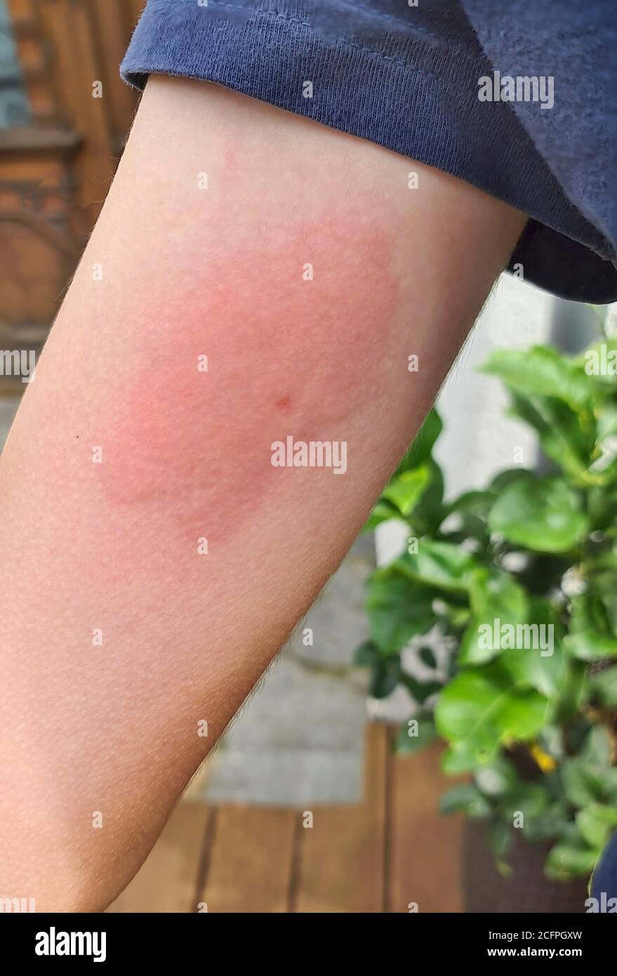 wasp pungendo ad un braccio di un bambino, Germania Foto Stock