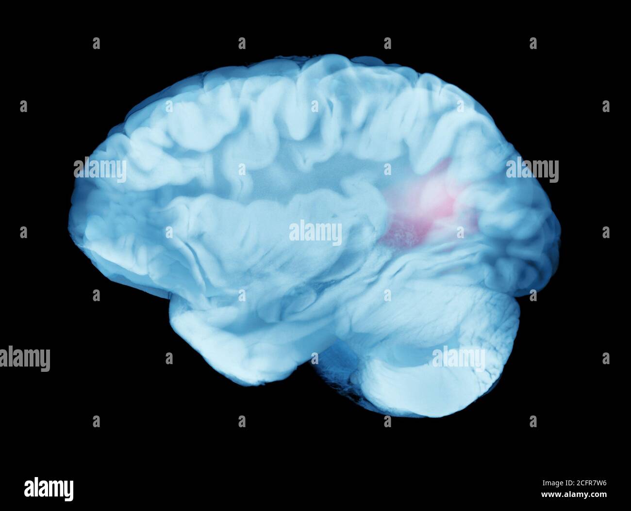 Aneurismi cerebrali cerebrali che causano ictus emorragico o paralisi Foto Stock