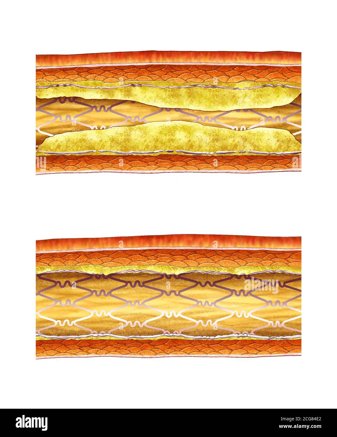 illustrazione anatomica della procedura di stent vascolare Foto Stock