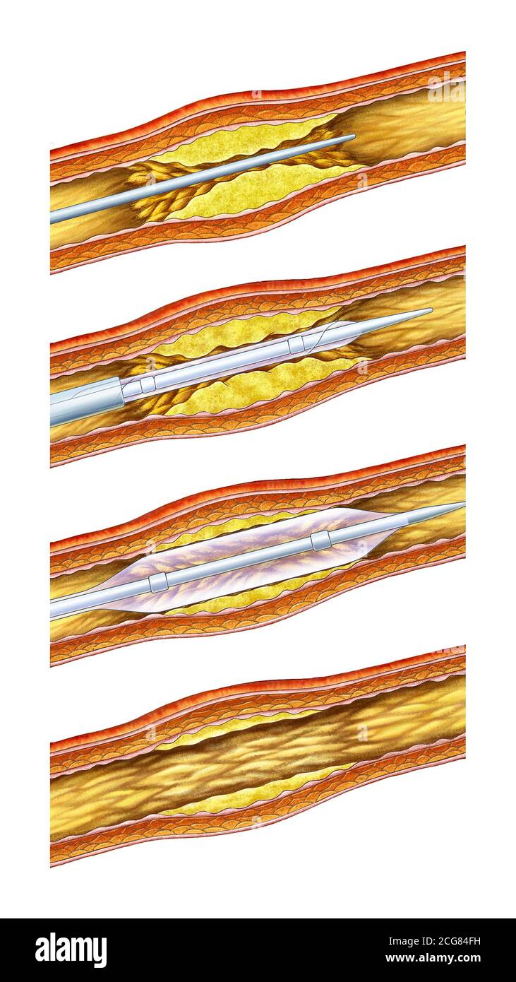 illustrazione anatomica della procedura di stent vascolare Foto Stock