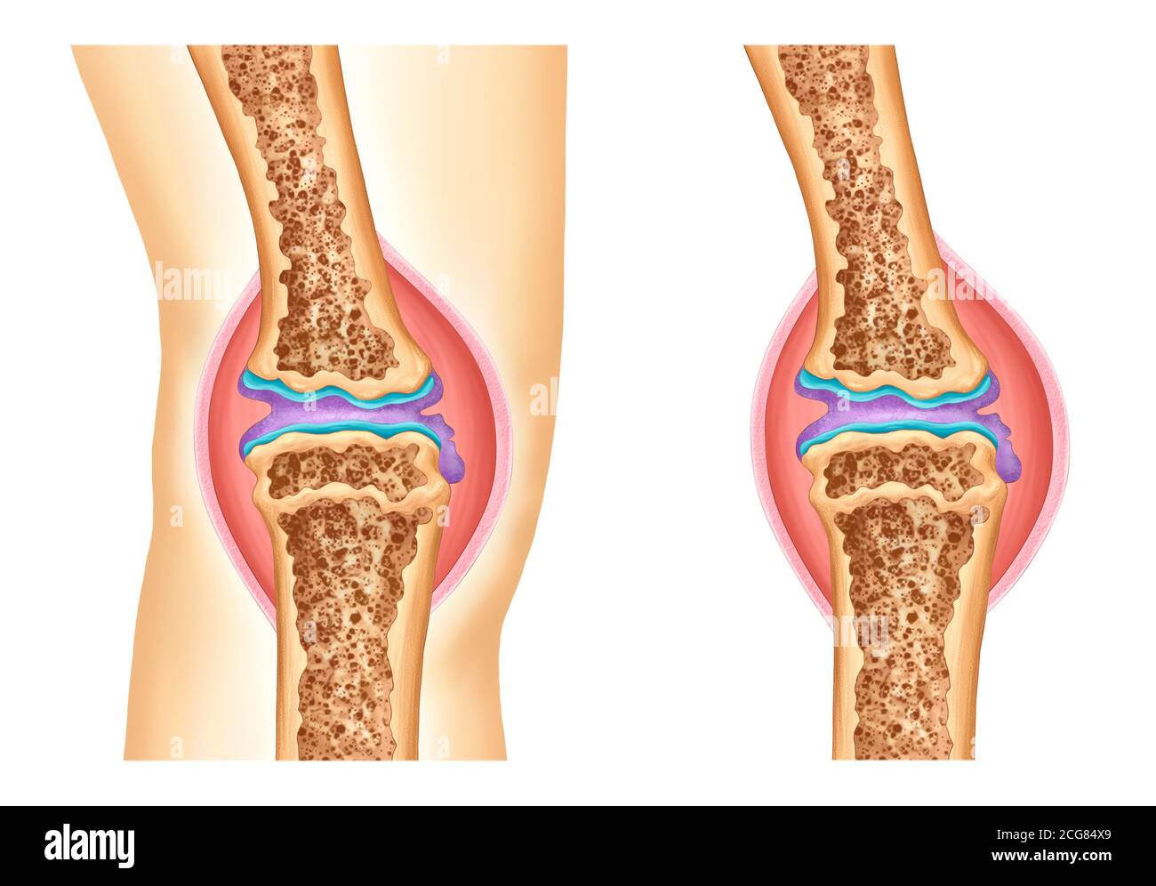 illustrazione anatomica dell'osteoartrite del ginocchio Foto Stock