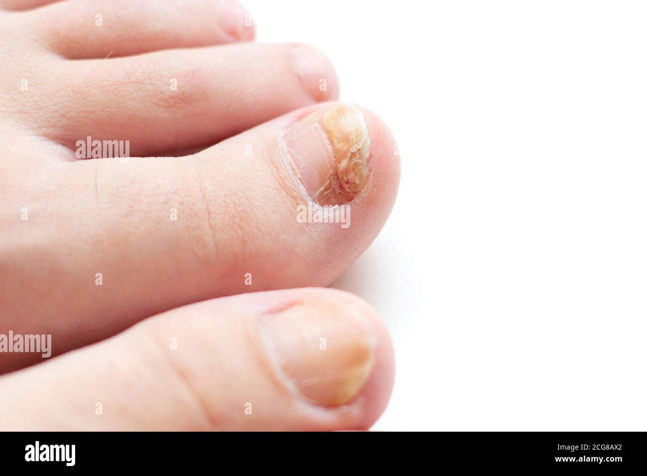 Fungo del chiodo sulla punta grande del piede Foto Stock