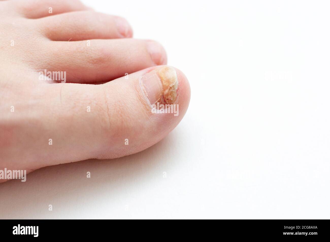 Primo piano di toenail con infezione da fungo Foto Stock