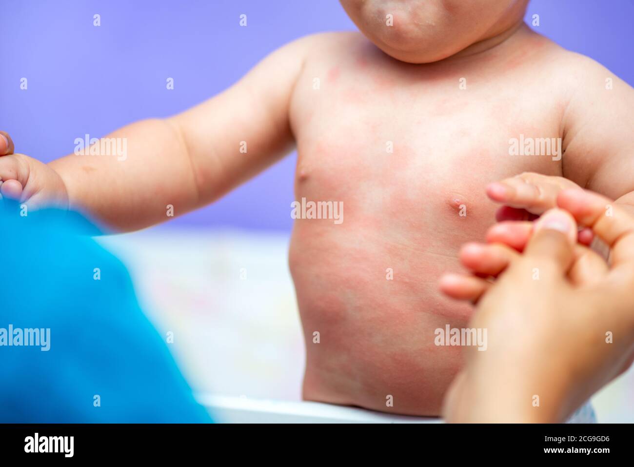 bambino piccolo con allergia in culla a casa Foto Stock