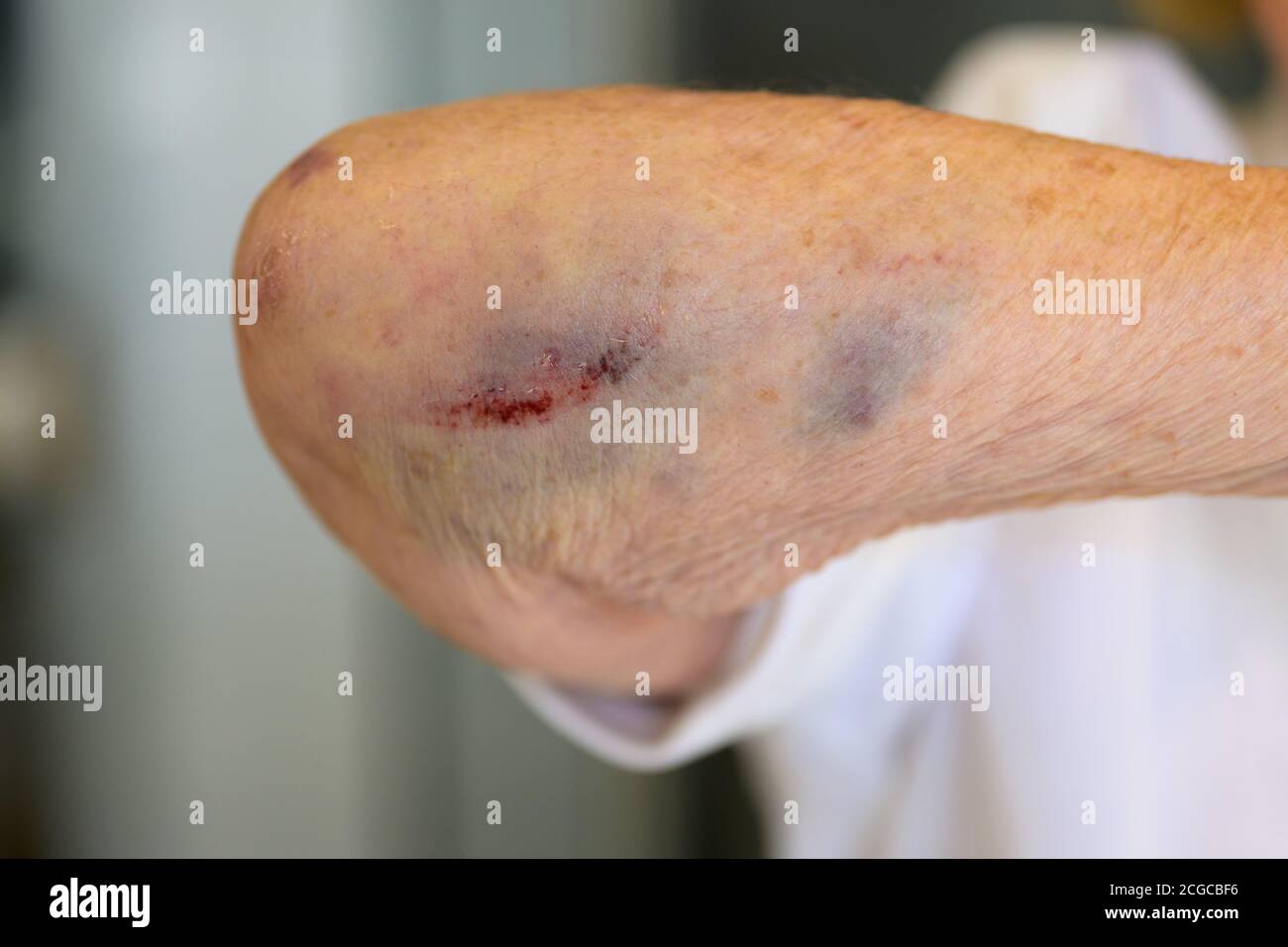 Donna anziana di 80 anni con gomito rotto o fratturato giunto che mostra il danno del tessuto molle e trauma a lei braccio dalla lesione Foto Stock