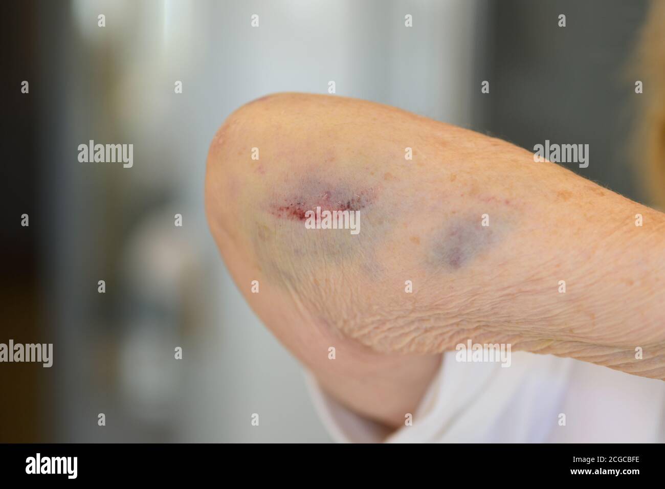 Donna anziana di 80 anni con gomito fratturato che mostra la lividi o contusione e trauma del tessuto molle della lesione in primo piano Foto Stock